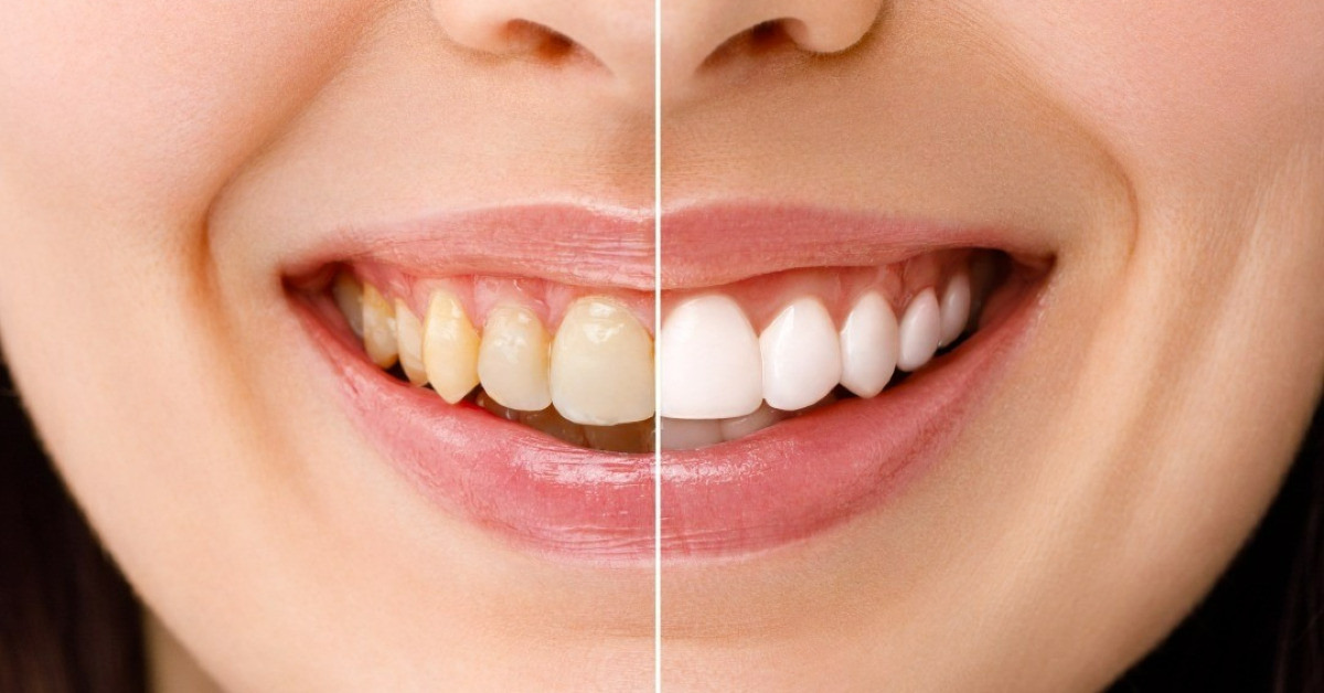 Teeth Whitening Options